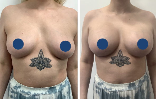 Breast Augmentation 762a1-2