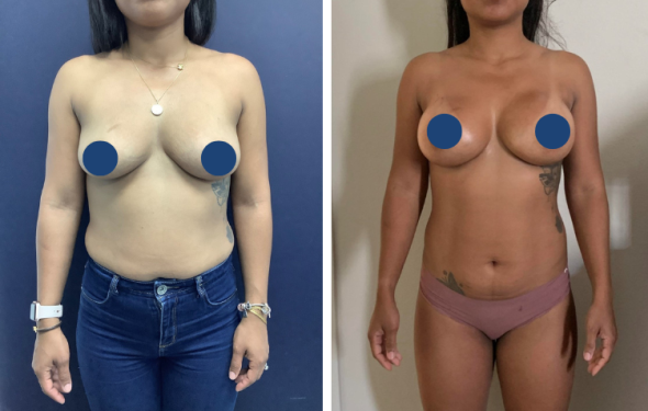 Breast Augmentation in Colombia