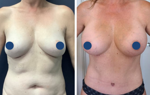 Breast Augmentation 824a1-2