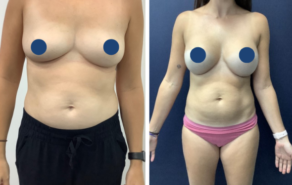 Breast Augmentation in Colombia