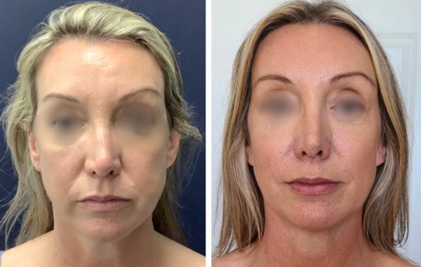 FACIAL FAT GRAFTING before and after 590 x 375.zip - facial fat grafting 737 a1-2 FACIAL FAT GRAFTING COLOMBIA
