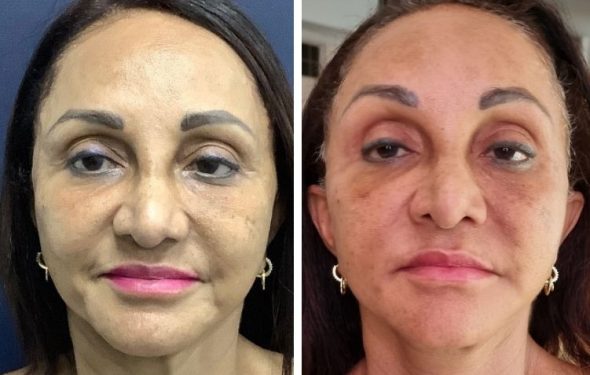 deep plane Facelift