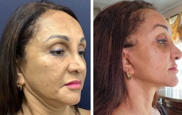 deep plane Facelift