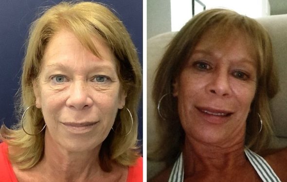 deep plane facelift