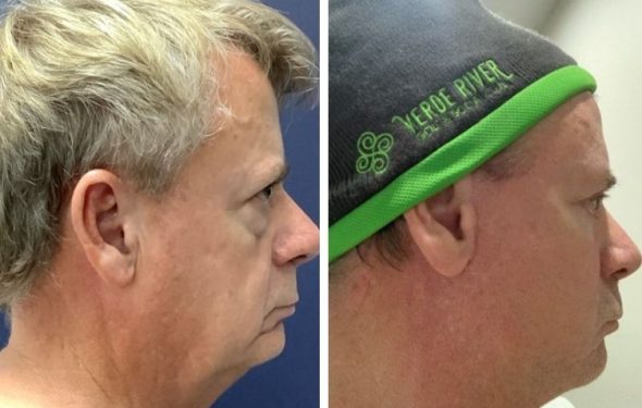 deep plane facelift