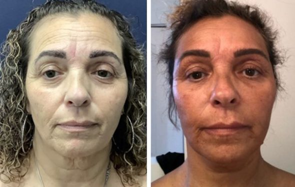 deep plane facelift