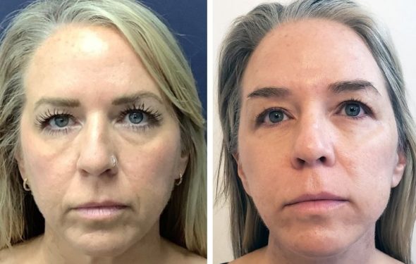 deep plane facelift