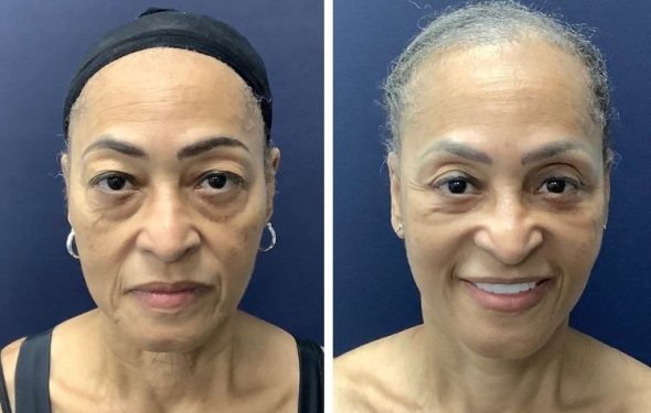 deep plane facelift