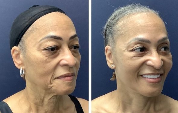 deep plane facelift