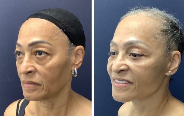 deep plane facelift