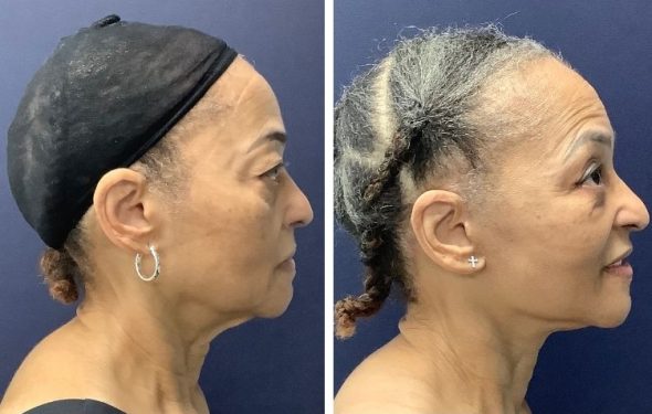 deep plane facelift