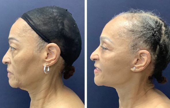 deep plane facelift