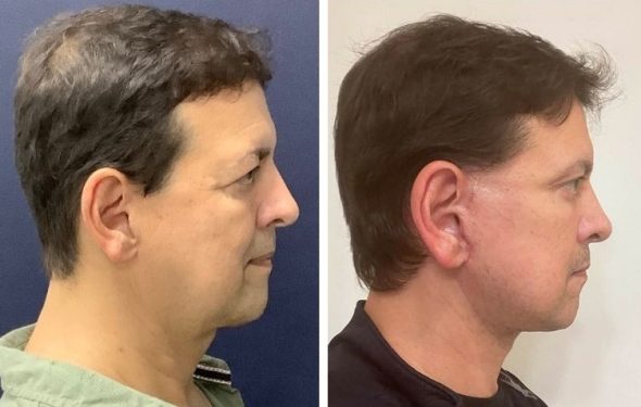 deep plane facelift