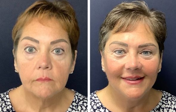 deep plane facelift