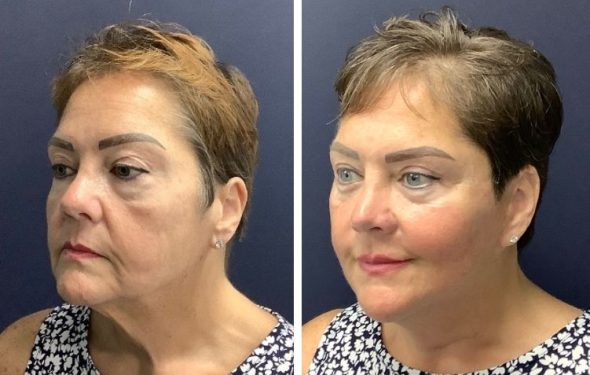deep plane facelift