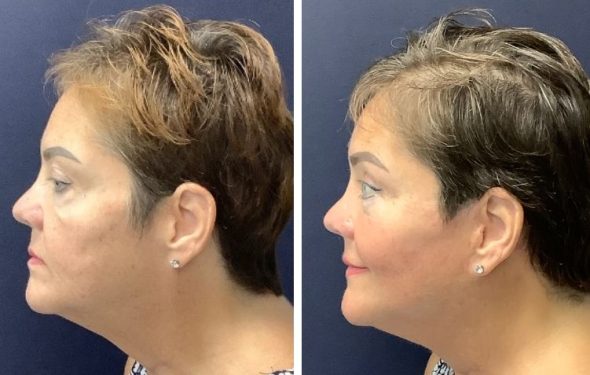 deep plane facelift