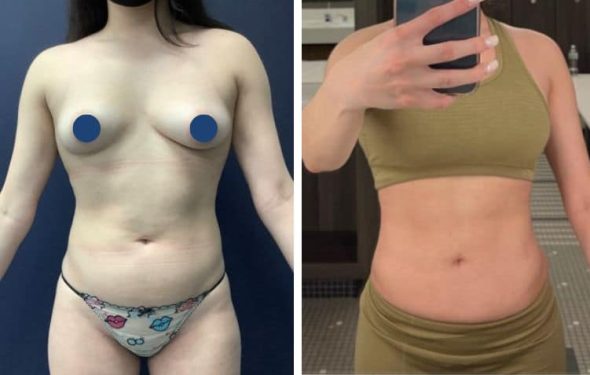 Liposuction 804a liposuction in colombia