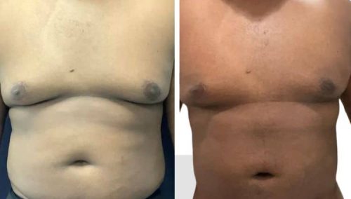 male breast reduction