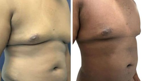 male breast reduction