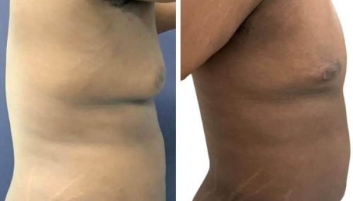 male breast reduction