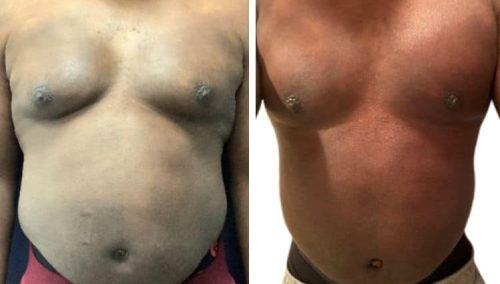 male breast reduction