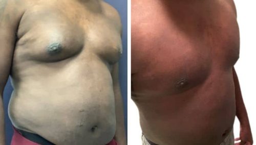 male breast reduction