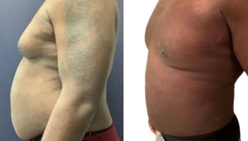 male breast reduction