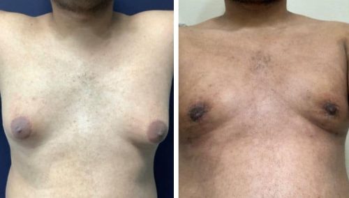 male breast reduction