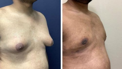 male breast reduction