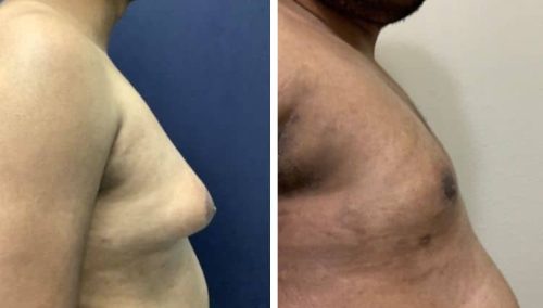 male breast reduction