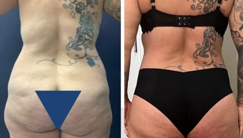 Posterior Body Lift Colombia