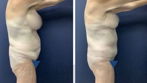 Posterior Body Lift Colombia