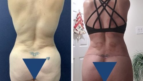 Posterior Body Lift Colombia