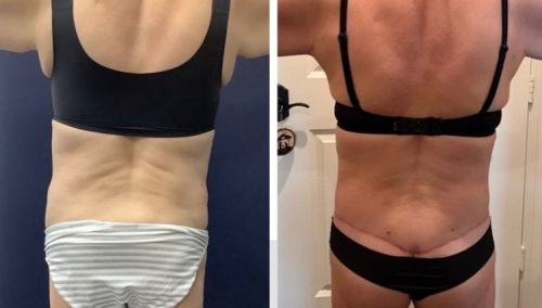 Posterior Body Lift Colombia