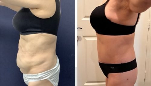 Posterior Body Lift Colombia