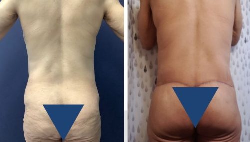 Posterior Body Lift Colombia