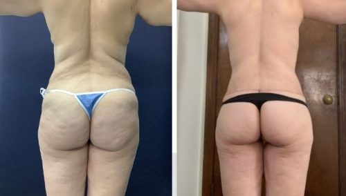 Posterior Body Lift Colombia