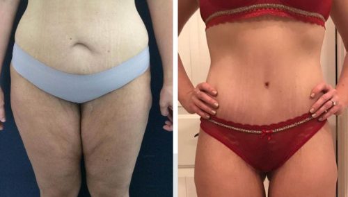 Thigh Lift colombia
