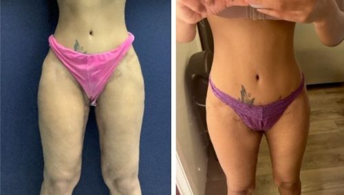 Thigh Lift colombia