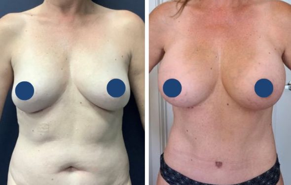 Tummy Tuck 824a Tummy Tuck in Colombia