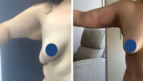Arm lift results in Colombia: Sleek and youthful arm contours.
