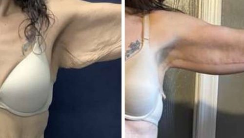 Surgical arm tightening in Colombia before and after gallery.