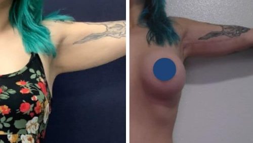 Achieving toned arms: Before and after brachioplasty surgery.
