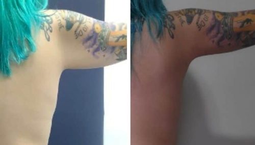 Board-certified arm lift outcomes in Colombia for North American patients.