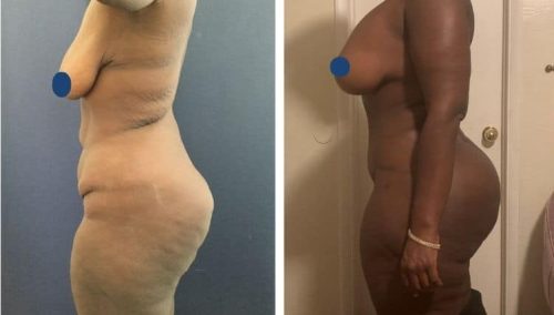 Restoring volume: Before and after buttock augmentation surgery in Colombia