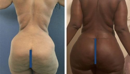 Restoring volume in Colombia: Before and after buttock augmentation surgery