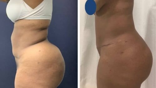 Premium Care: Luxury buttock enhancement outcomes in Colombia