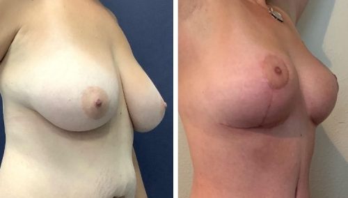 Correcting nipple placement in Colombia: Before and after breast lift