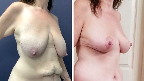 Toned and lifted Colombia: Breast lift results after weight loss