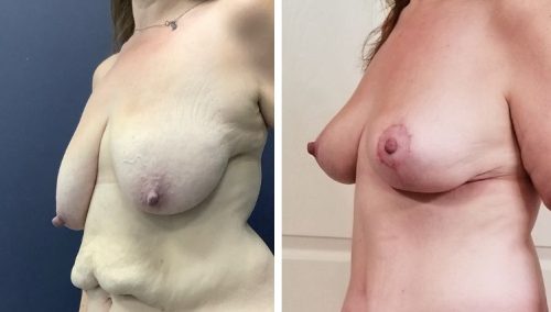 Toned and lifted: Breast lift results after weight loss in Colombia